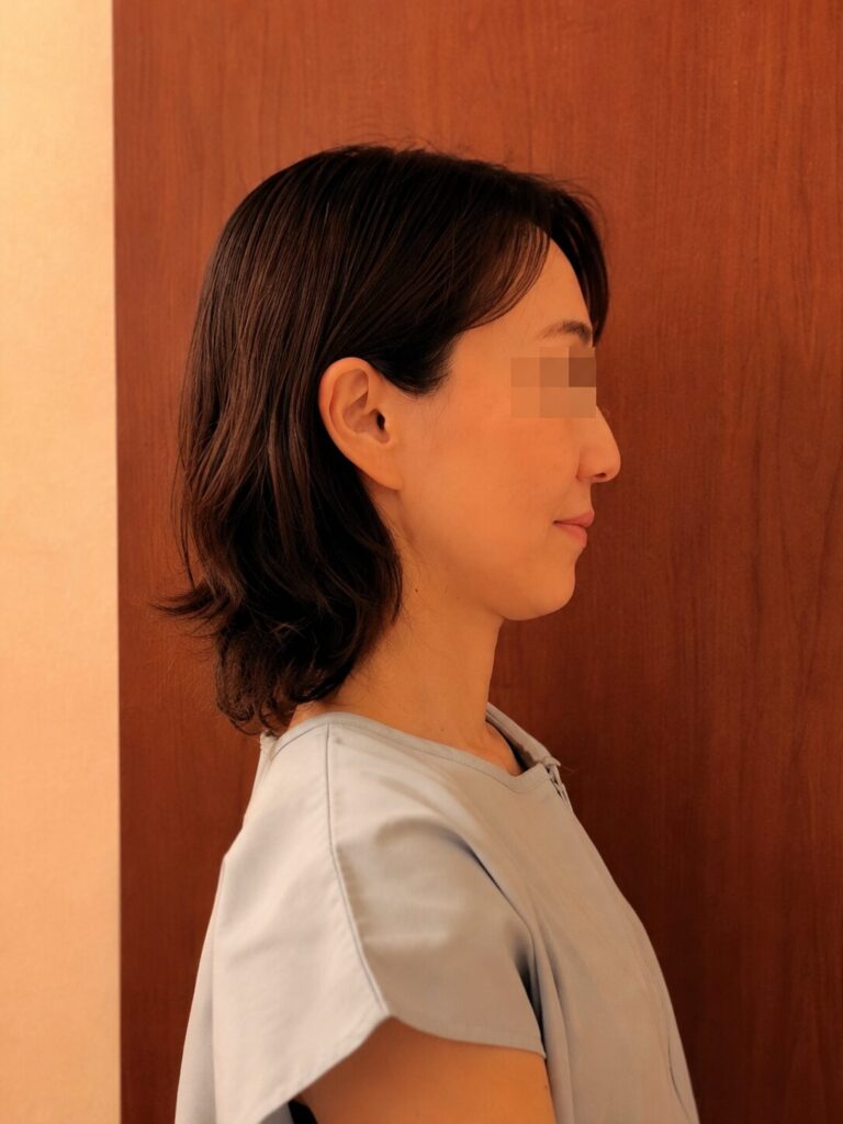 美容鍼の施術前のフェイスライン（ビフォー）