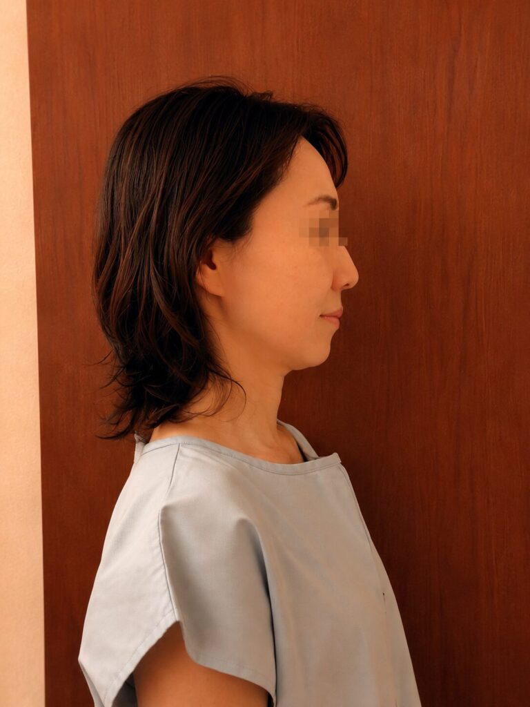 美容鍼の施術後のフェイスライン（アフター）